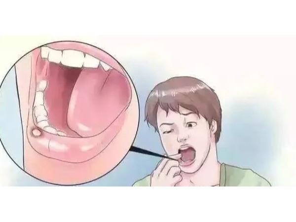 口腔潰瘍反反復復，補充維C就能好？