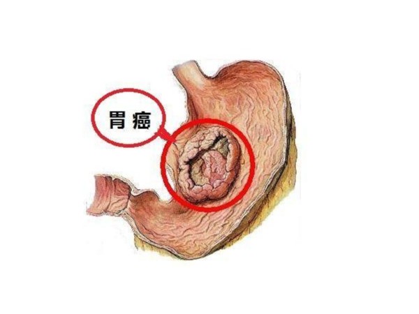 硒元素和胃癌之間的秘密關系